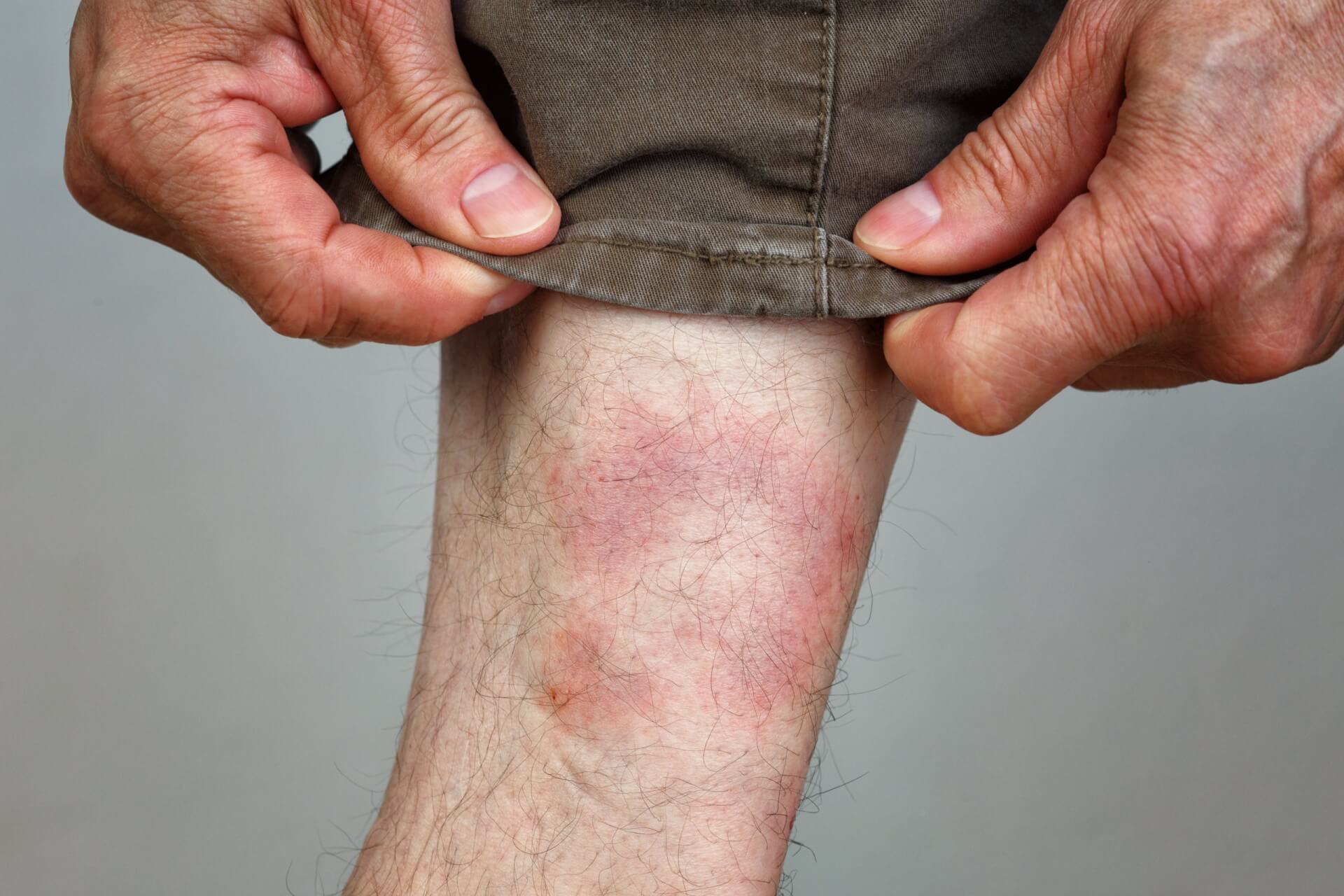 Eine Person zieht ihr Hosenbein hoch, um einen ger&ouml;teten, entz&uuml;ndeten Hautfleck am Unterschenkel zu entdecken, der m&ouml;glicherweise auf eine Reizung, einen Ausschlag oder eine Infektion hinweist.