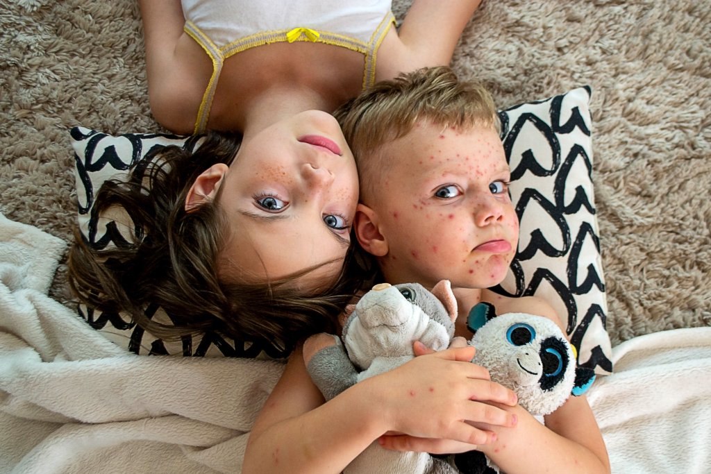 Zwei Kinder liegen auf einem Kissen mit Herzmuster; das eine ist gesund, w&auml;hrend das andere, das m&ouml;glicherweise an G&uuml;rtelrose (Herpes Zoster) erkrankt ist, rote Flecken im Gesicht und am K&ouml;rper hat. Sie kuscheln mit Pl&uuml;schtieren und blicken in die Kamera.