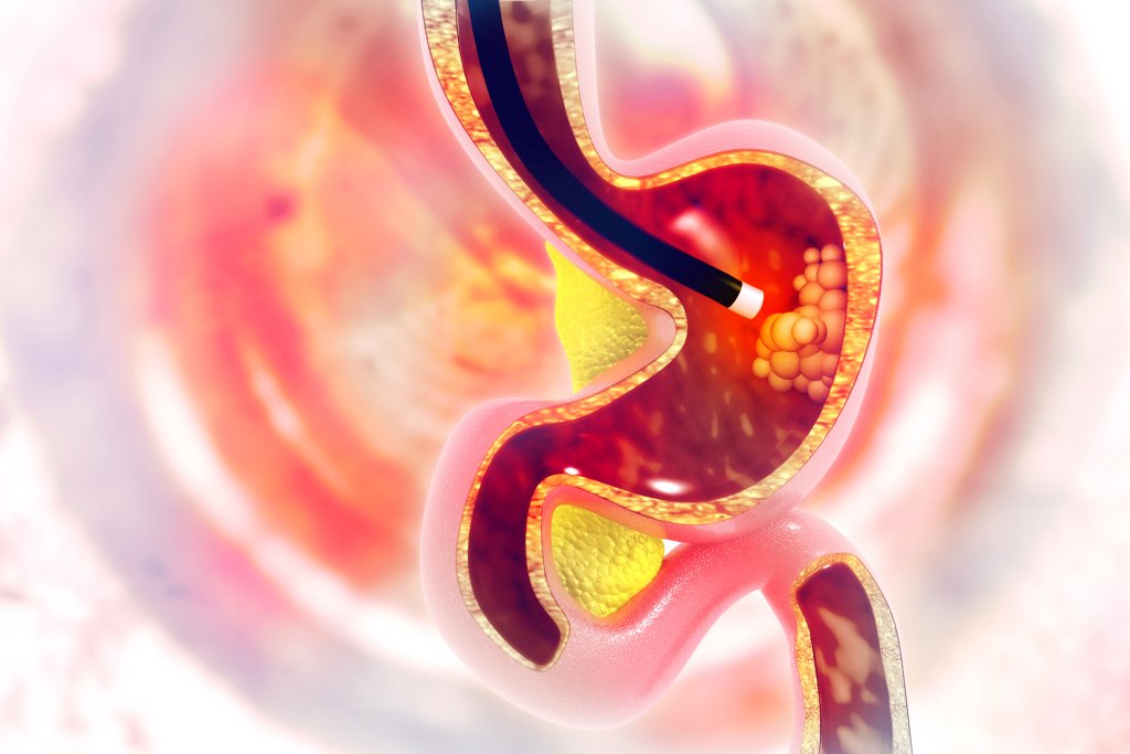 Medizinische Illustration, die eine Nahaufnahme und einen Querschnitt eines Magens zeigt, in den ein schwarzer Schlauch eingef&uuml;hrt wurde. M&ouml;glicherweise handelt es sich um eine Endoskopie zur Diagnose von Z&ouml;liakie oder Glutenunvertr&auml;glichkeit. Im Inneren des Magens sind gelbe Substanzen zu sehen.