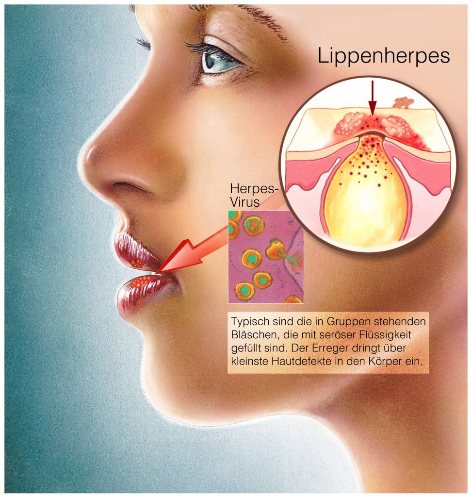 Lippenherpes