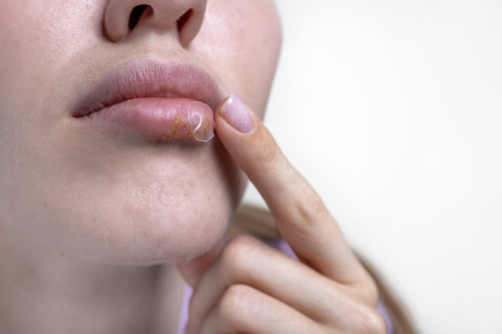 cold sores hpv virus herpes on girl female big beautiful lips.wo