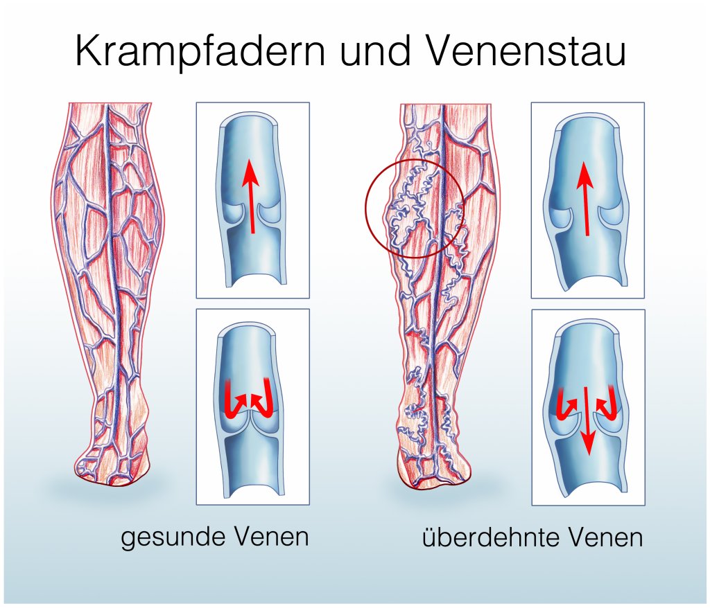 Krampfadern und Venenstau