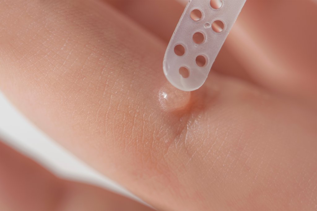 Eine Nahaufnahme eines Fingers mit einer kleinen Blase, w&auml;hrend ein durchsichtiger Pflasterverband mit Bel&uuml;ftungsl&ouml;chern angelegt wird - ideal nach Behandlungen wie Warze entfernen.
